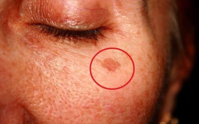 Cosa significa avere queste macchie sul viso e come eliminarle (1 / 2) onMay 17, 2026