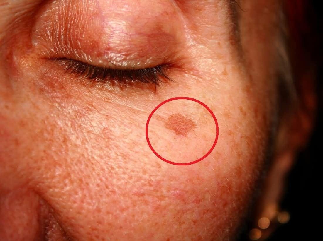 Cosa significa avere queste macchie sul viso e come eliminarle (1 / 2) onMay 17, 2026